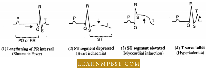 Circulation In Animals Blood Vascular System Abnormalities In ECG